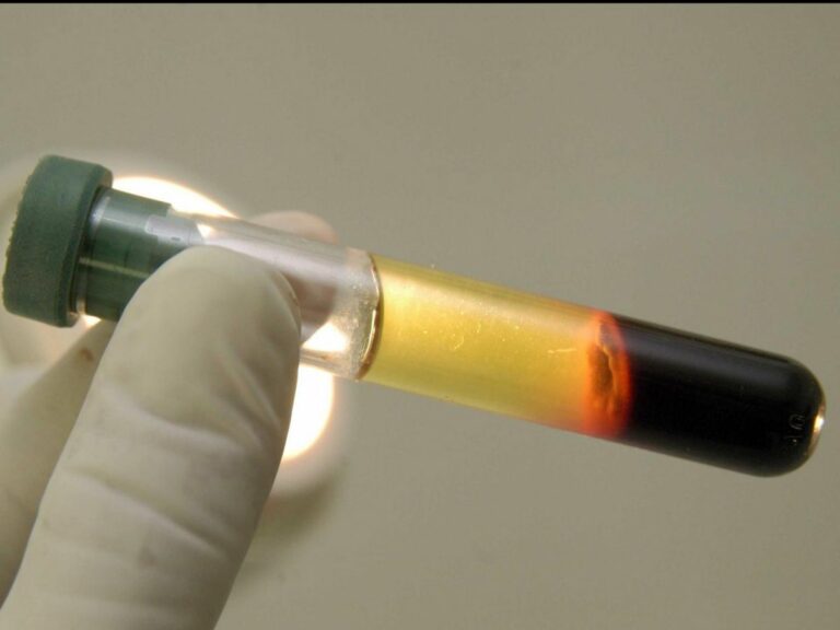 Éprouvette de sang centrifugé montrant la séparation des lipides